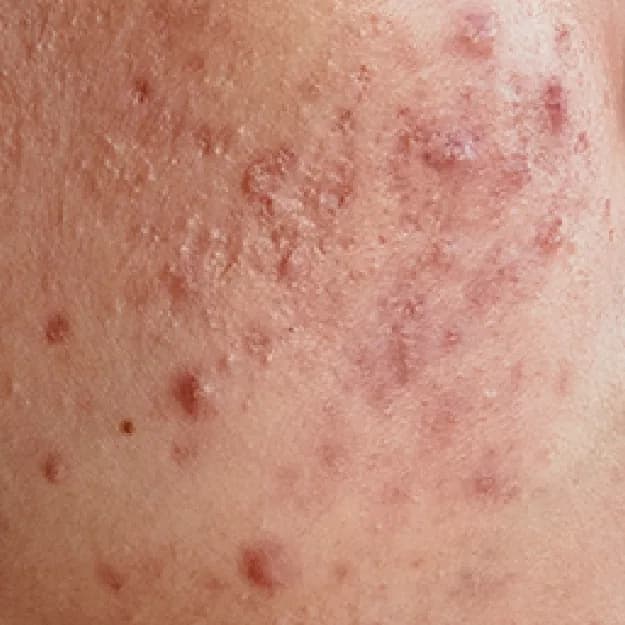 Acne — Adult-Onset Acne