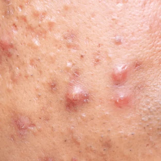 Acne — Comedonal Acne