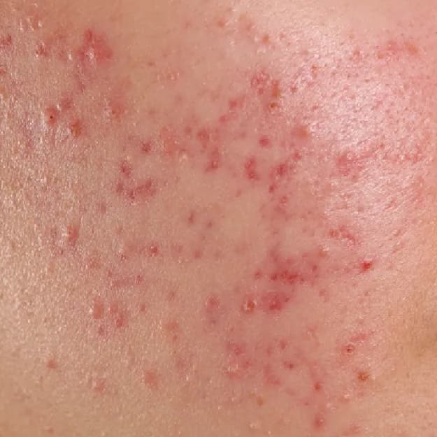 Acne — Cystic Acne