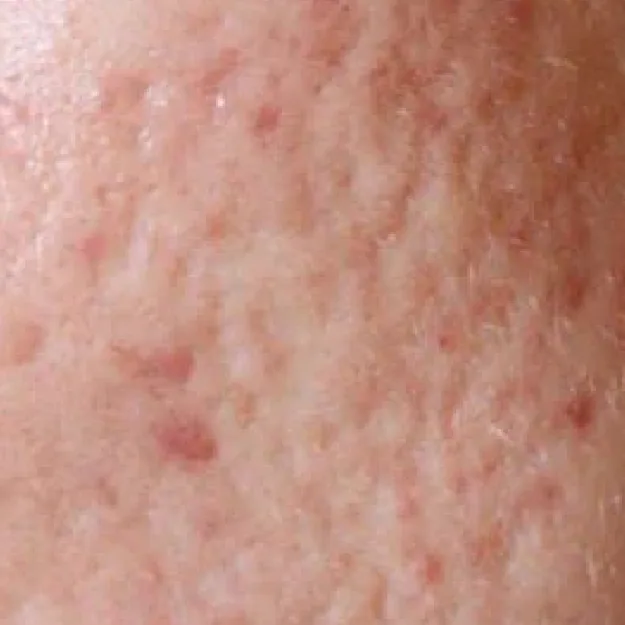 Acne Scars — Atrophic / Indented Acne Scars