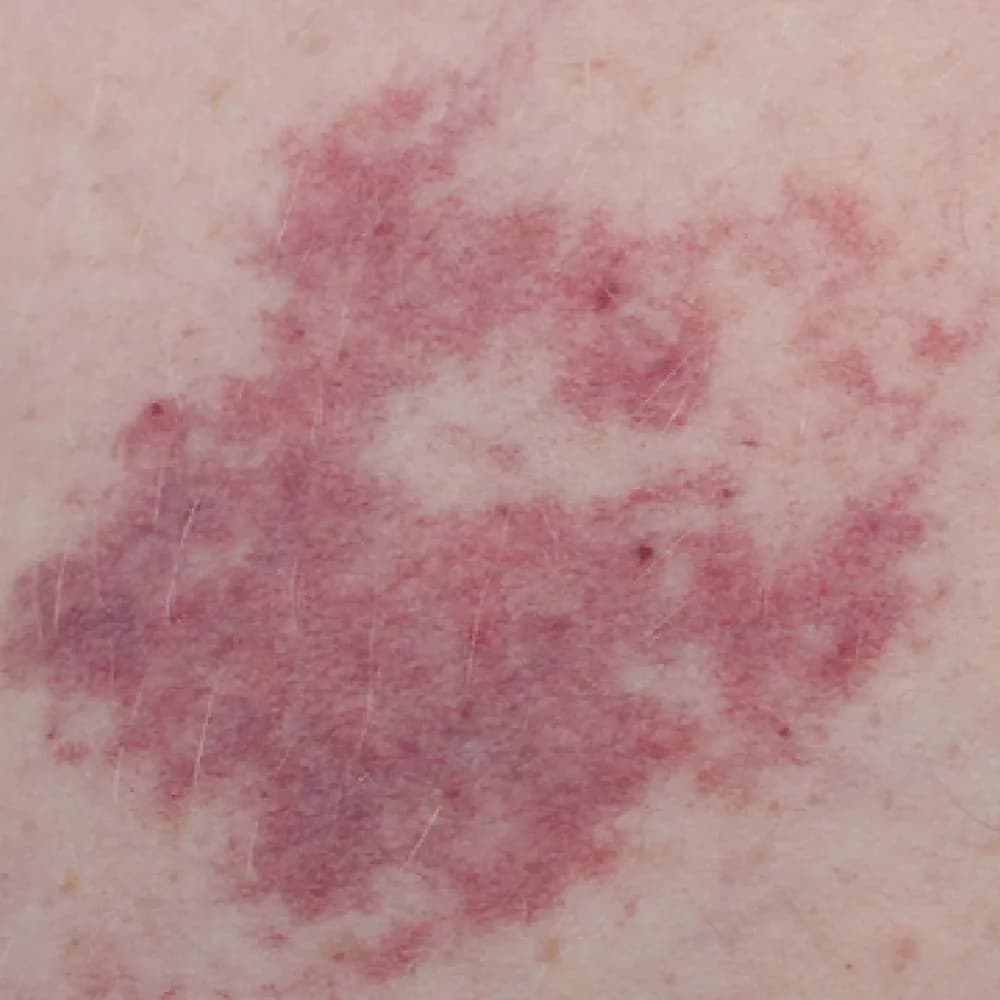 Birthmark — Pigmented Birthmarks