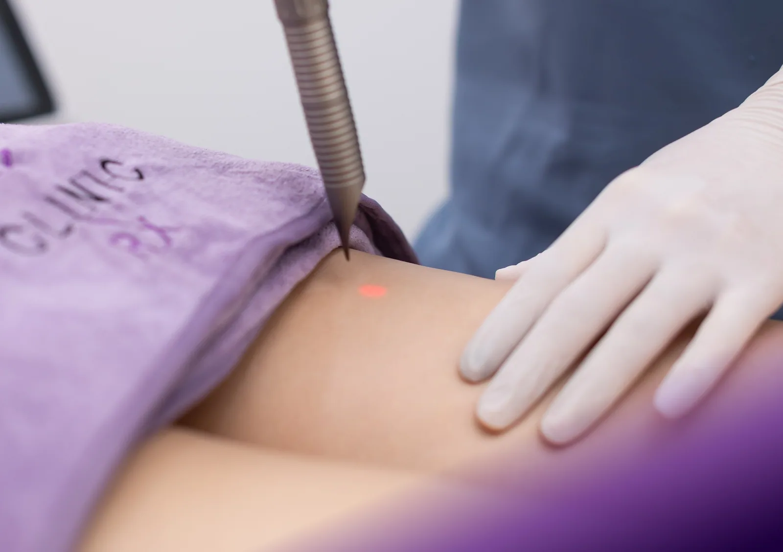 Fotona TightSculpting treatment at Clinic RX
