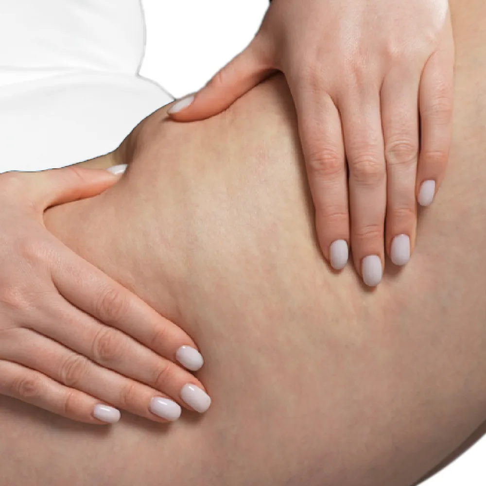 Cellulite — Grade 1 — Mild
