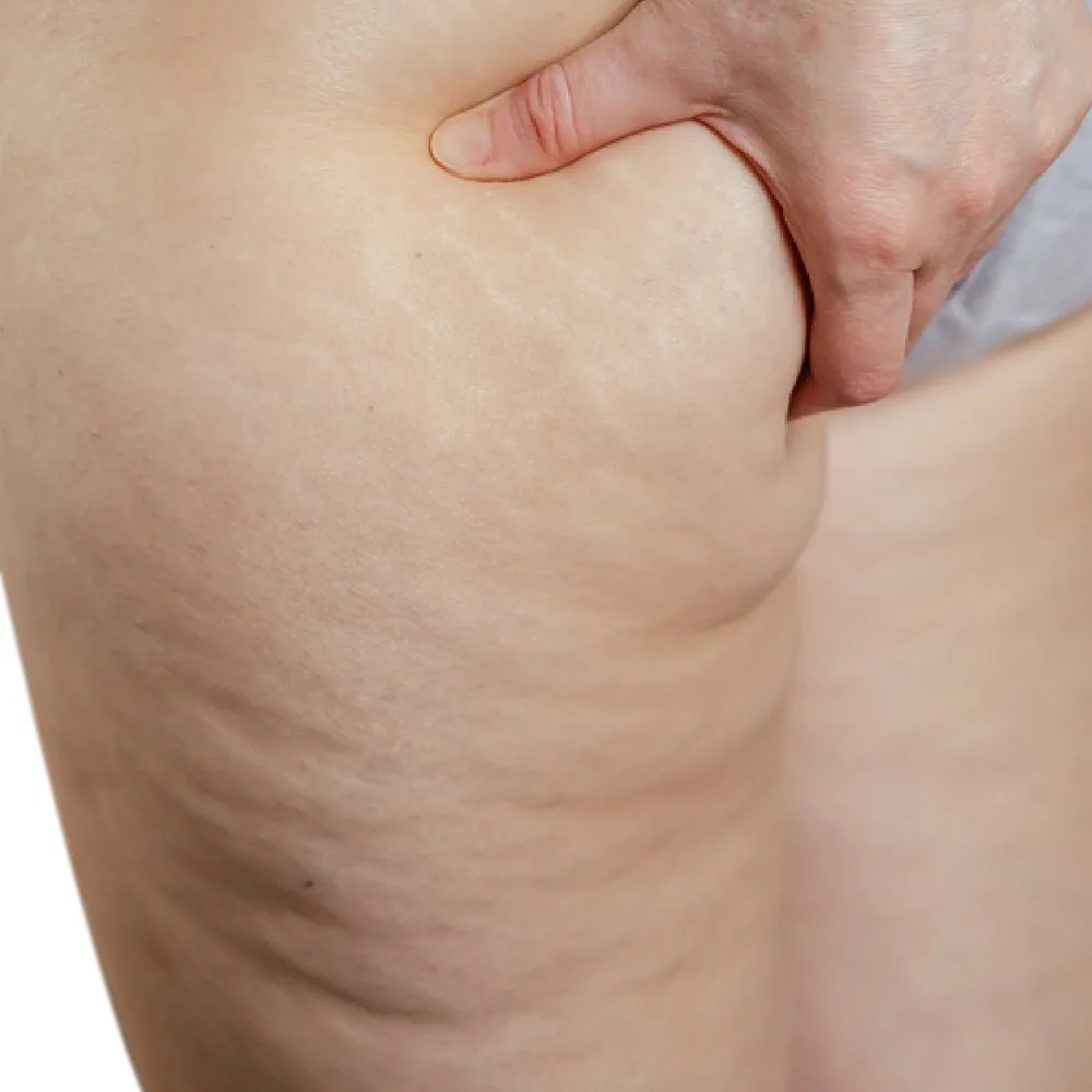 Cellulite — Grade 2 — Moderate