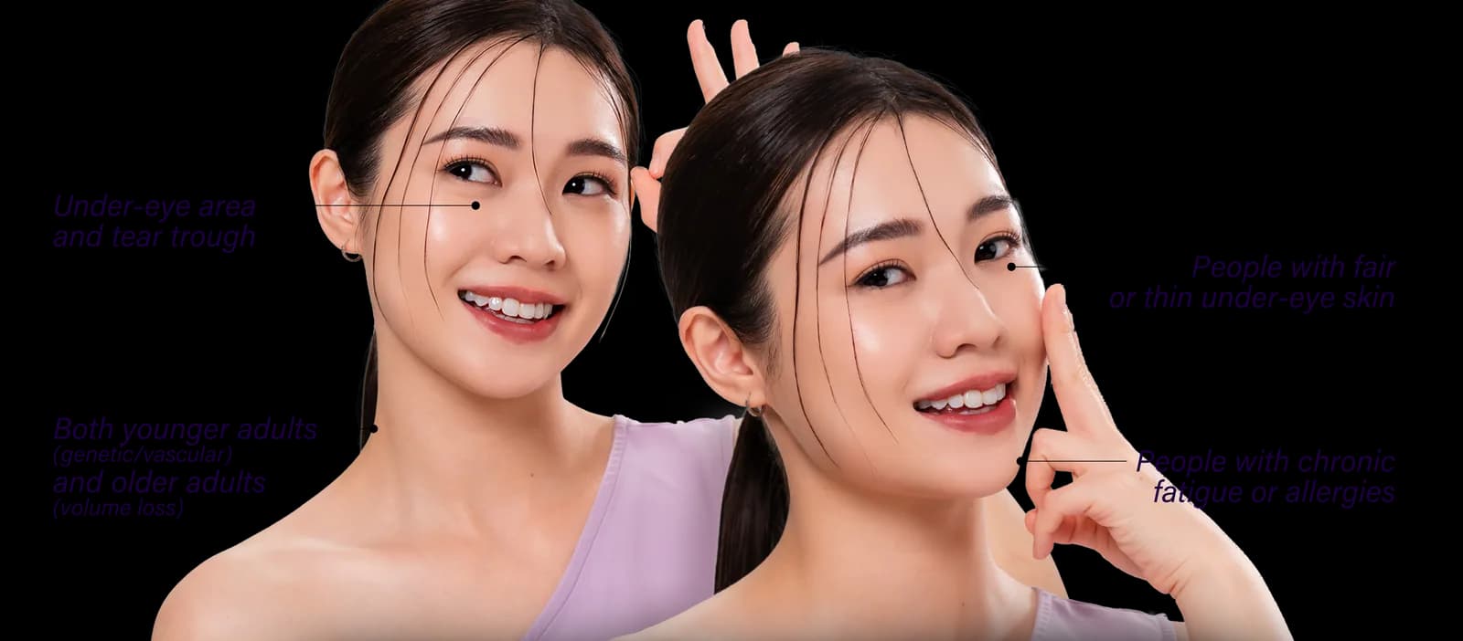 Areas of the face affected by dark eye circles