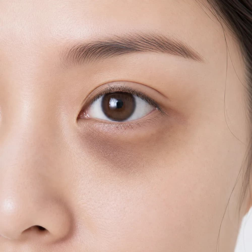 Dark Eye Circles — Vascular Dark Circles