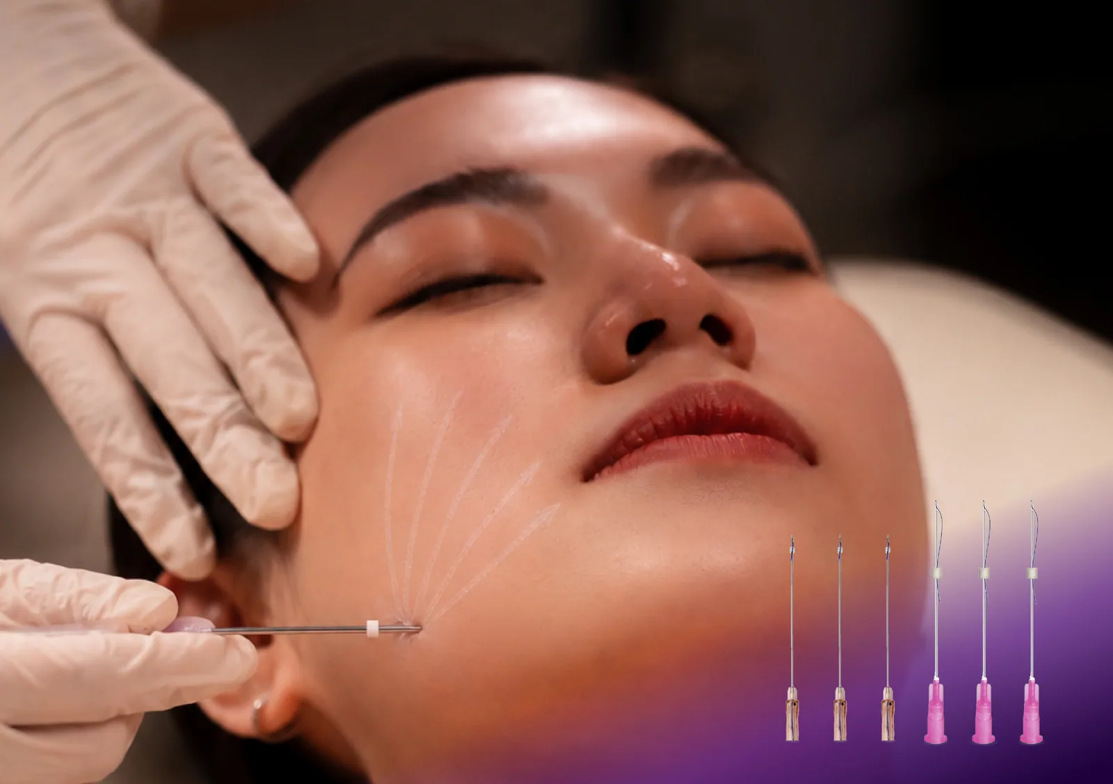 Face Thread Lift treatment at Clinic RX