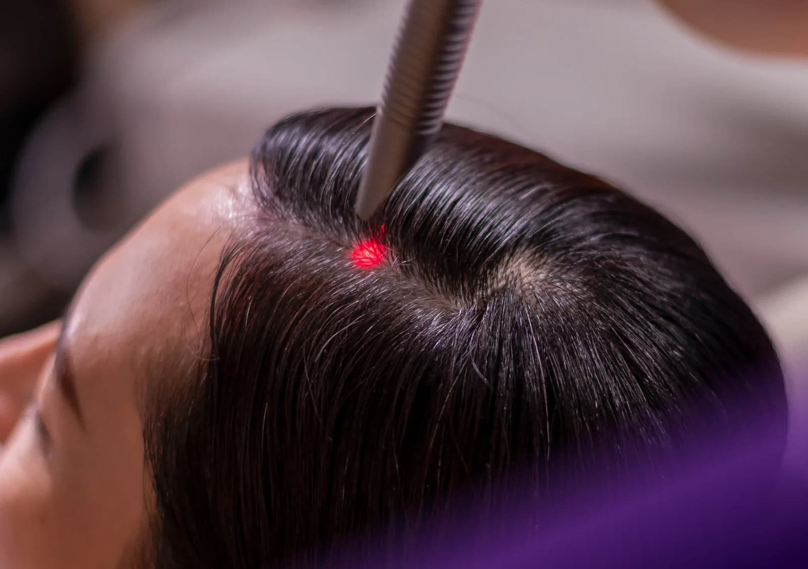 Fotona Hair Growth Laser treatment at Clinic RX