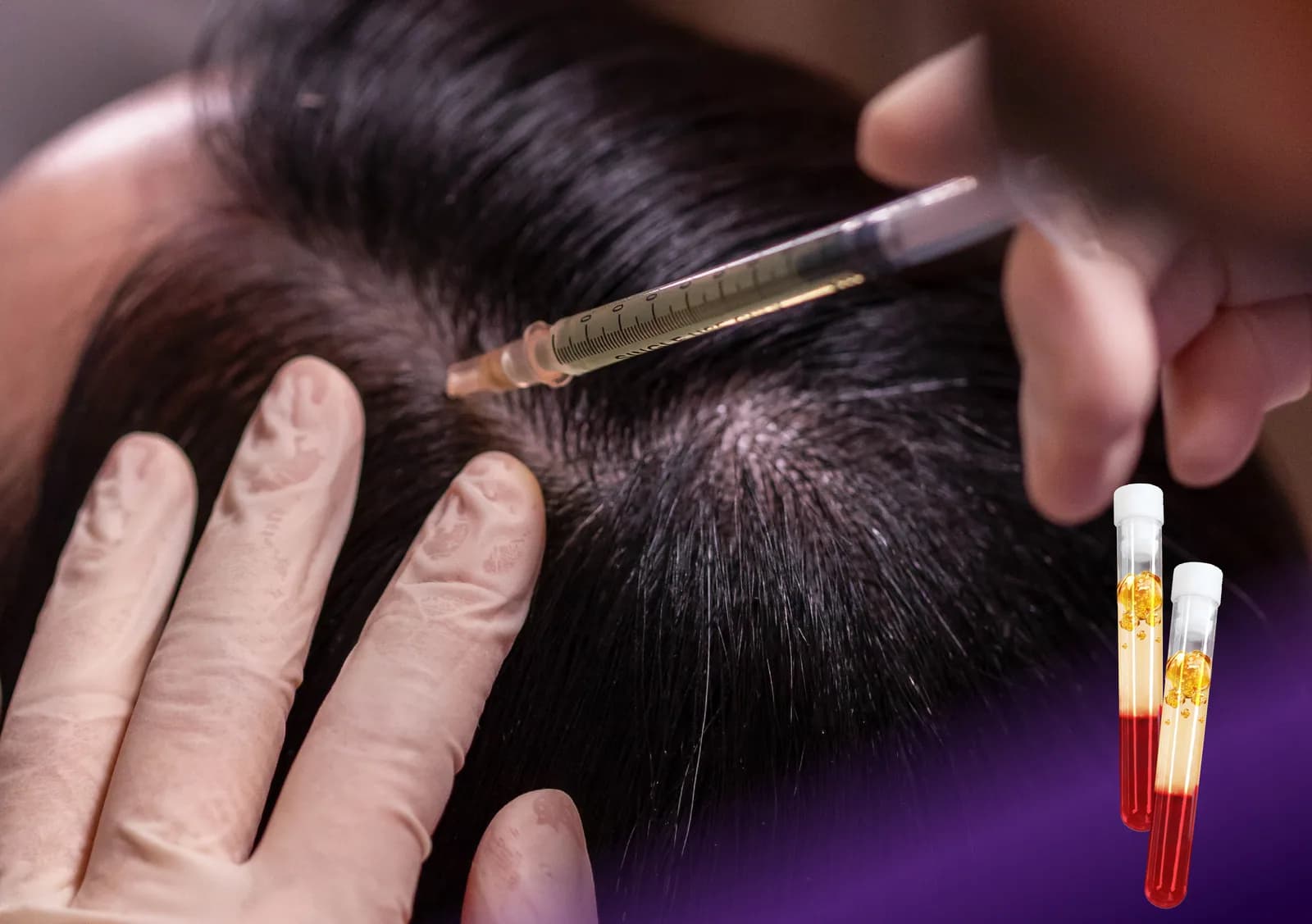 PRP Hair Treatment treatment at Clinic RX
