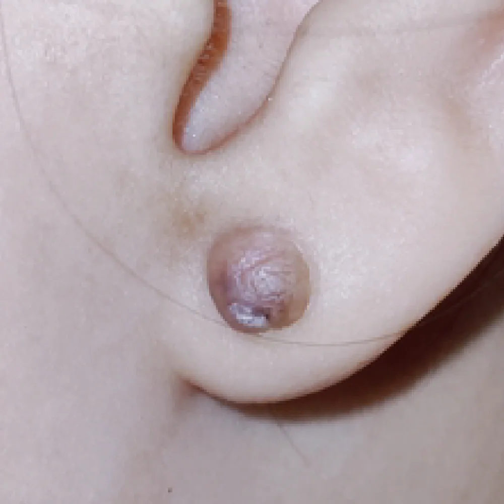 Keloid — Recurrent Keloid