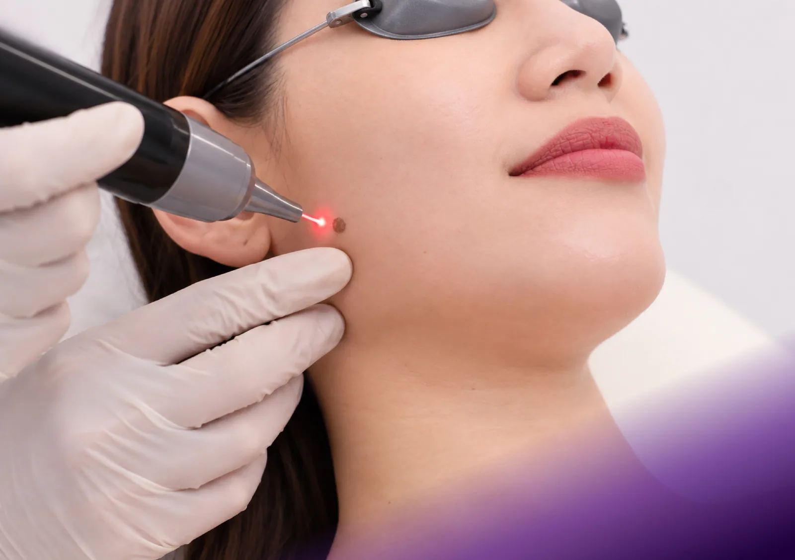 Milia & Mole Removal treatment at Clinic RX