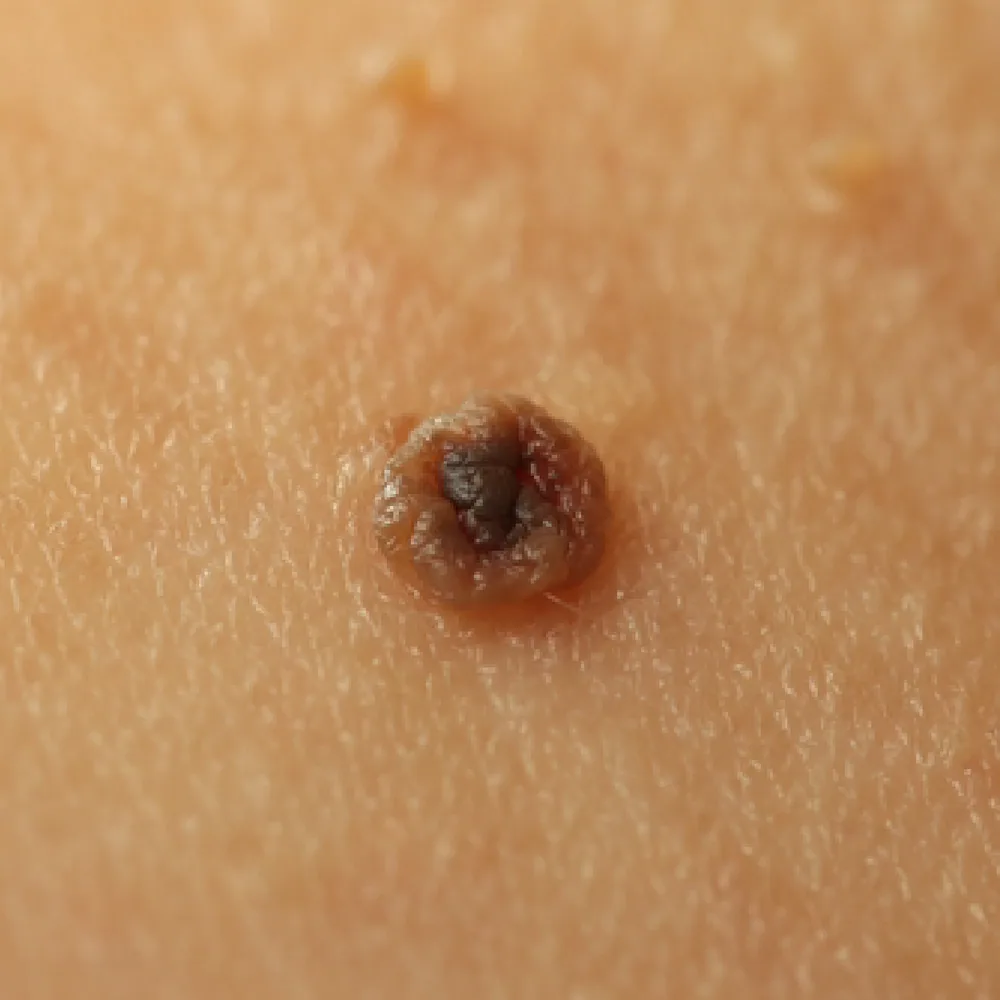 Mole — Flat Moles