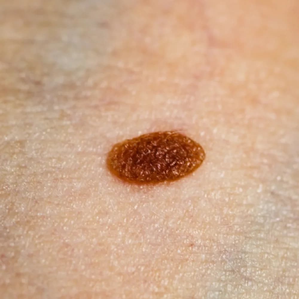 Mole — Acquired Moles