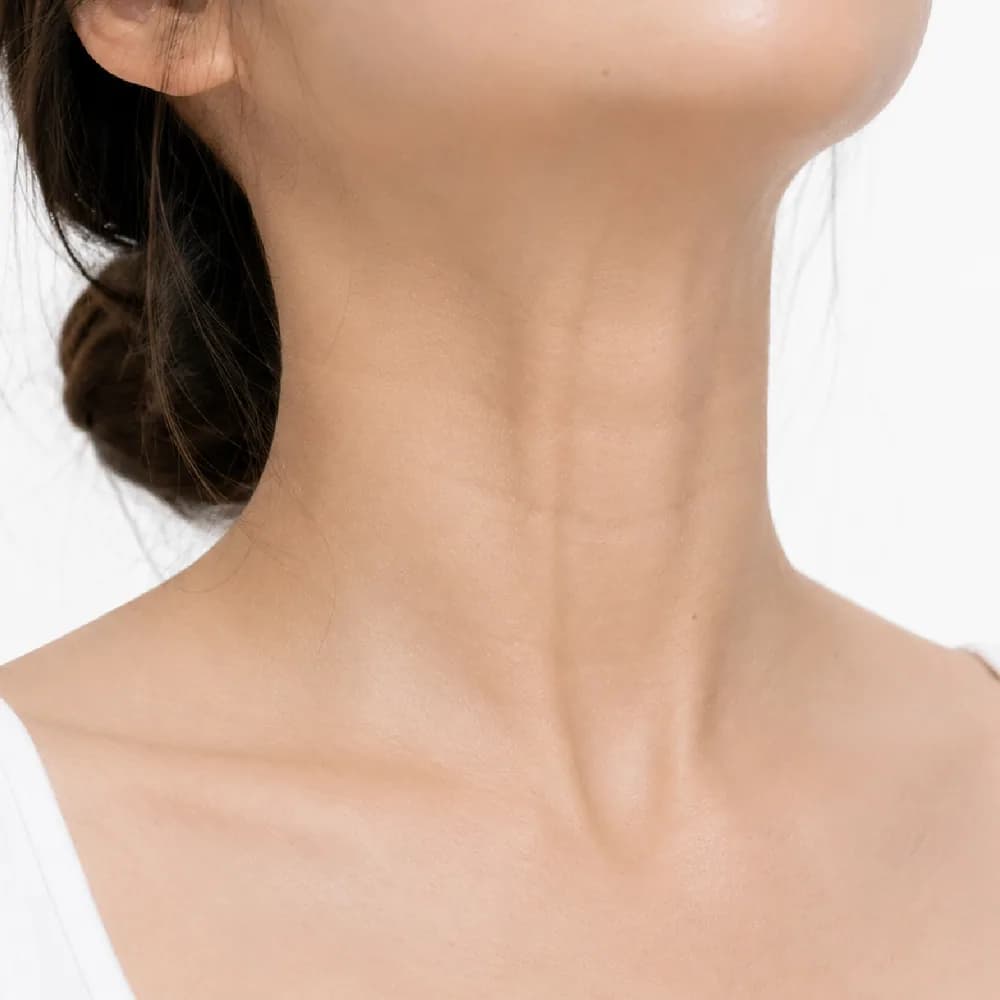 Neck Lines — Platysma Bands