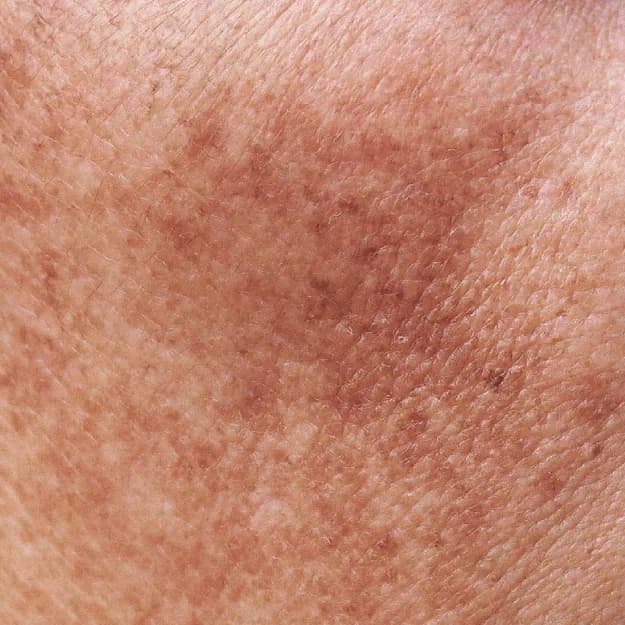 Pigmentation — Melasma
