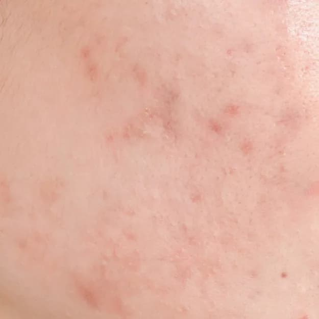 Pigmentation — Post-Inflammatory Hyperpigmentation (PIH)