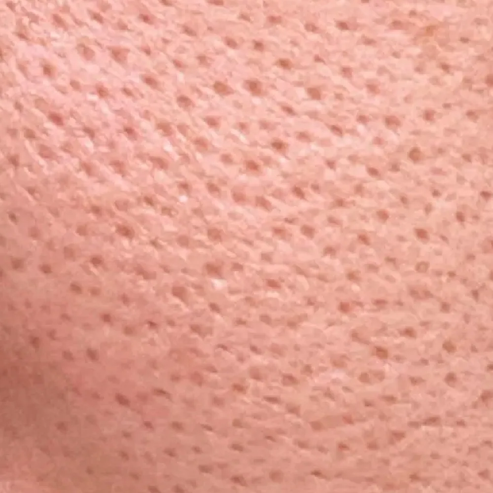 Uneven Skin Texture — Enlarged Pores