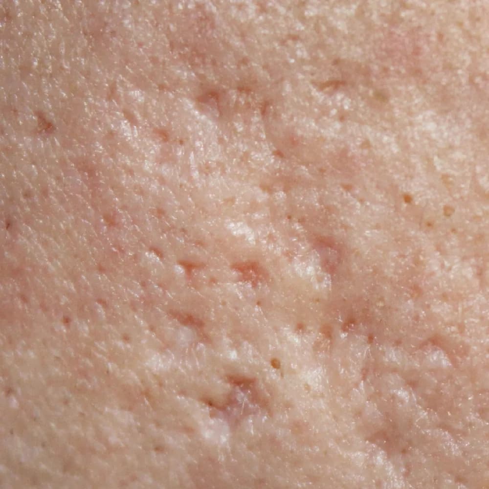 Uneven Skin Texture — Bumpy / Congested Texture