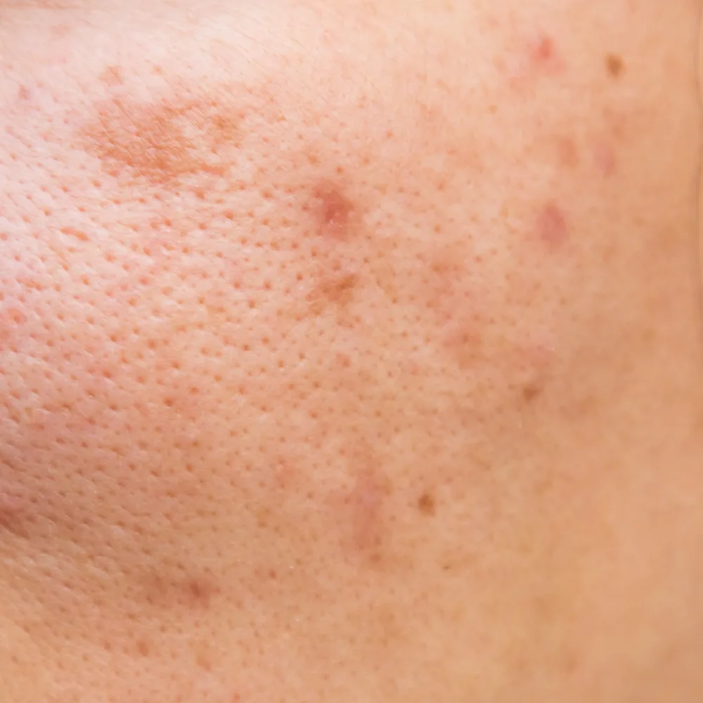 Uneven Skin Texture — Uneven Surface