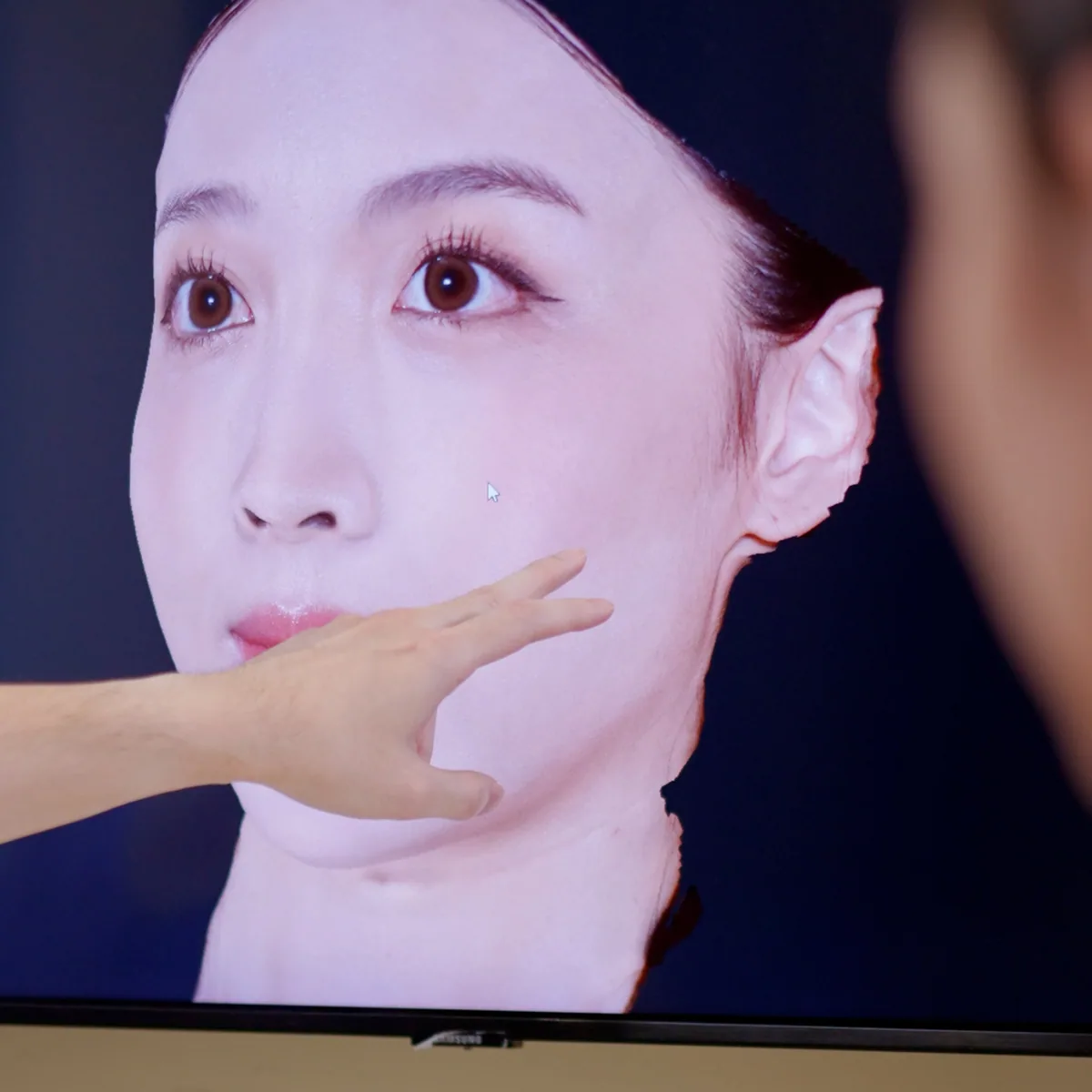 Botulinum Toxin treatment step 1