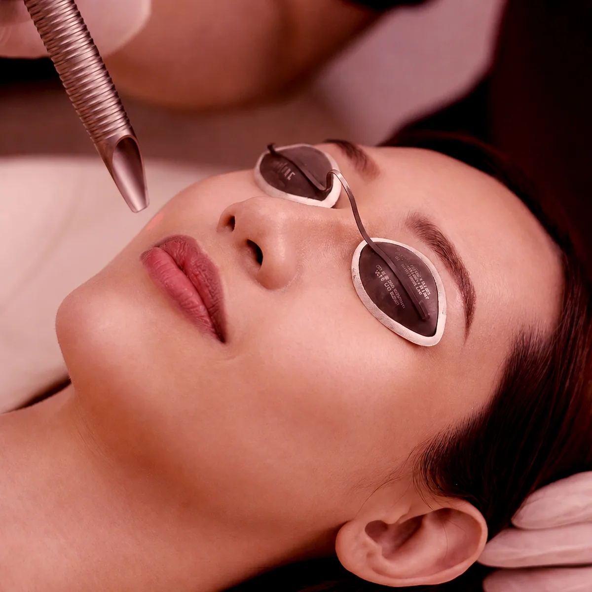 Fotona 4D treatment step 3