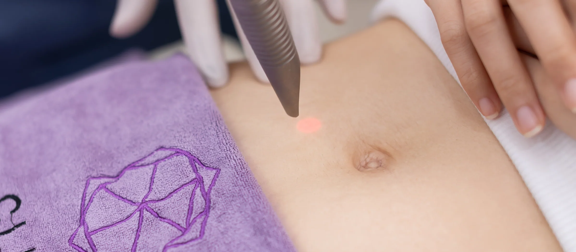 Fotona TightSculpting treatment in progress