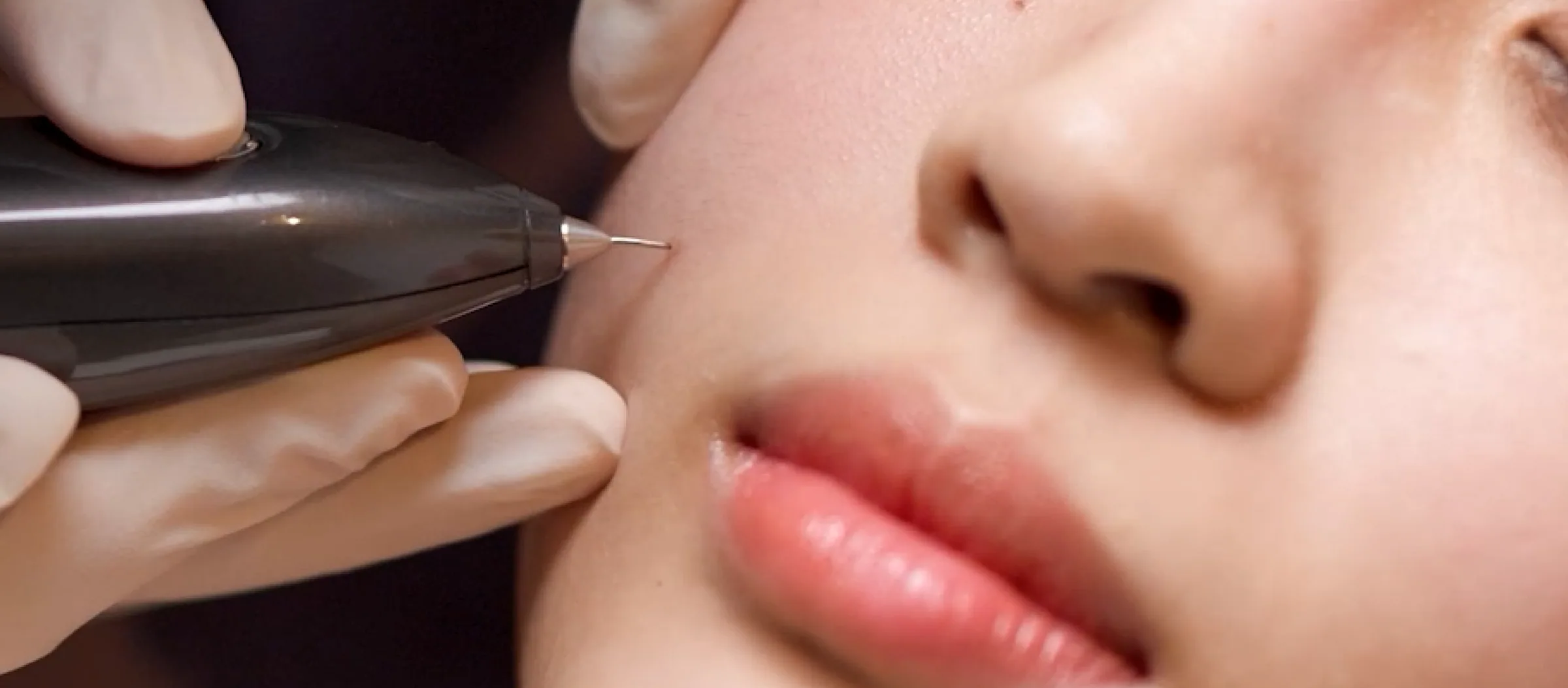 Milia and mole removal treatment in progress