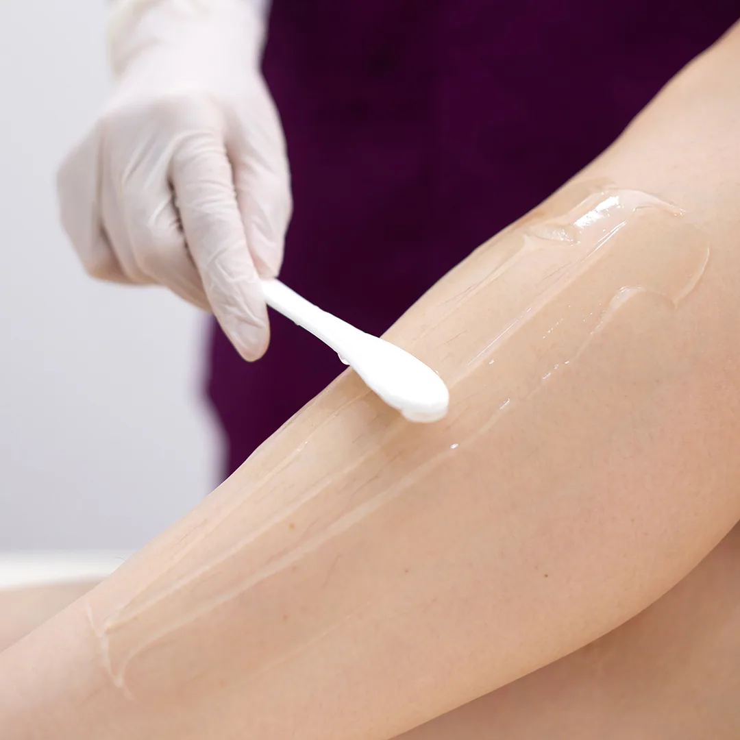 Vascular Laser treatment step 2