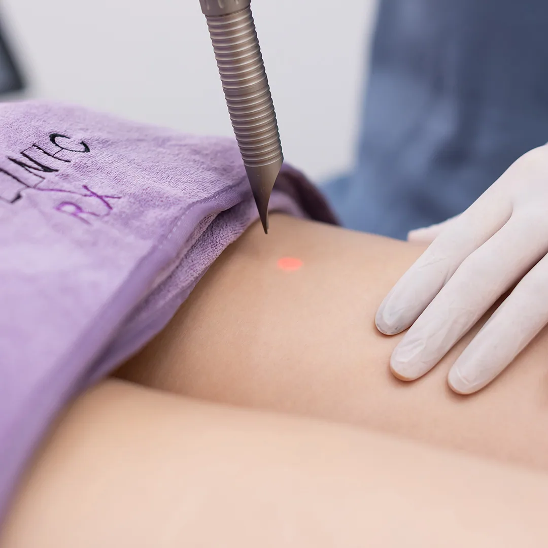 Vascular Laser treatment step 3