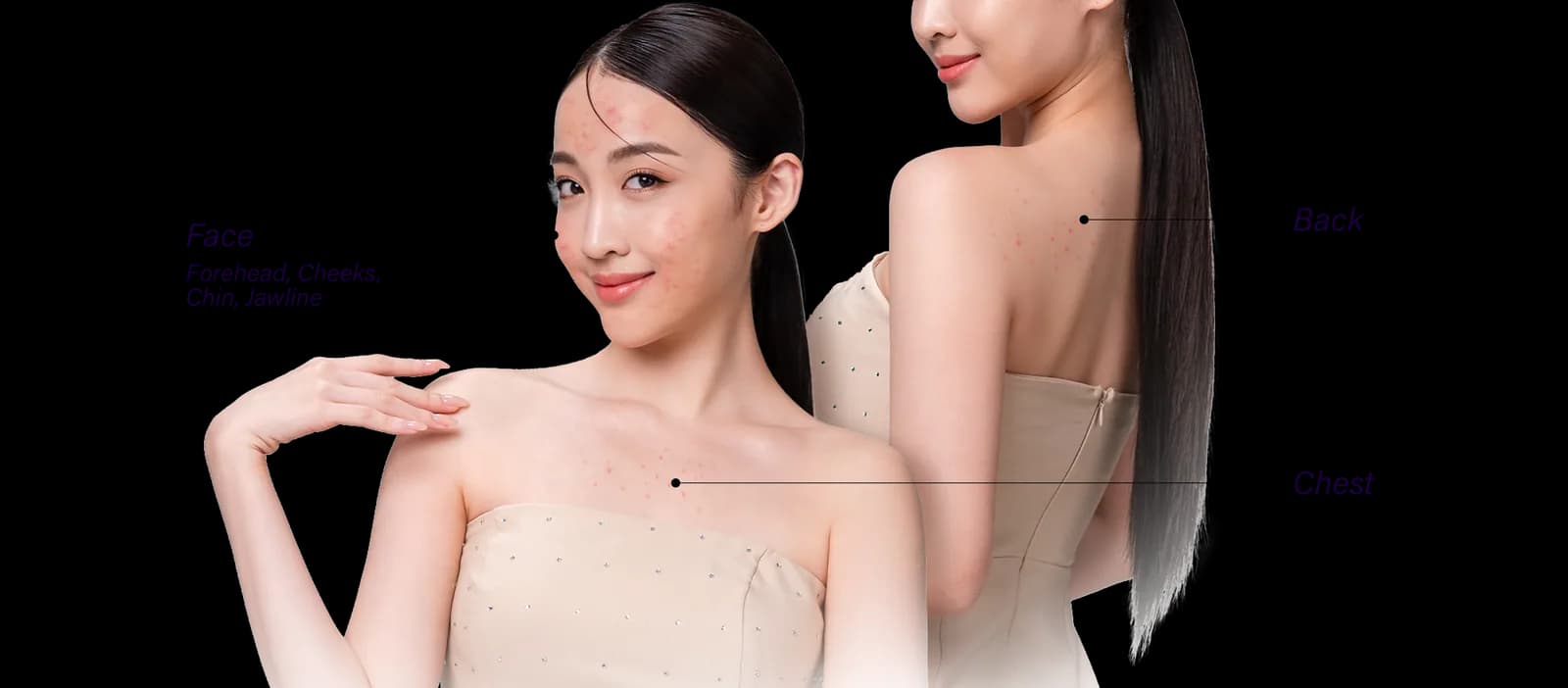 Areas of the face affected by acne