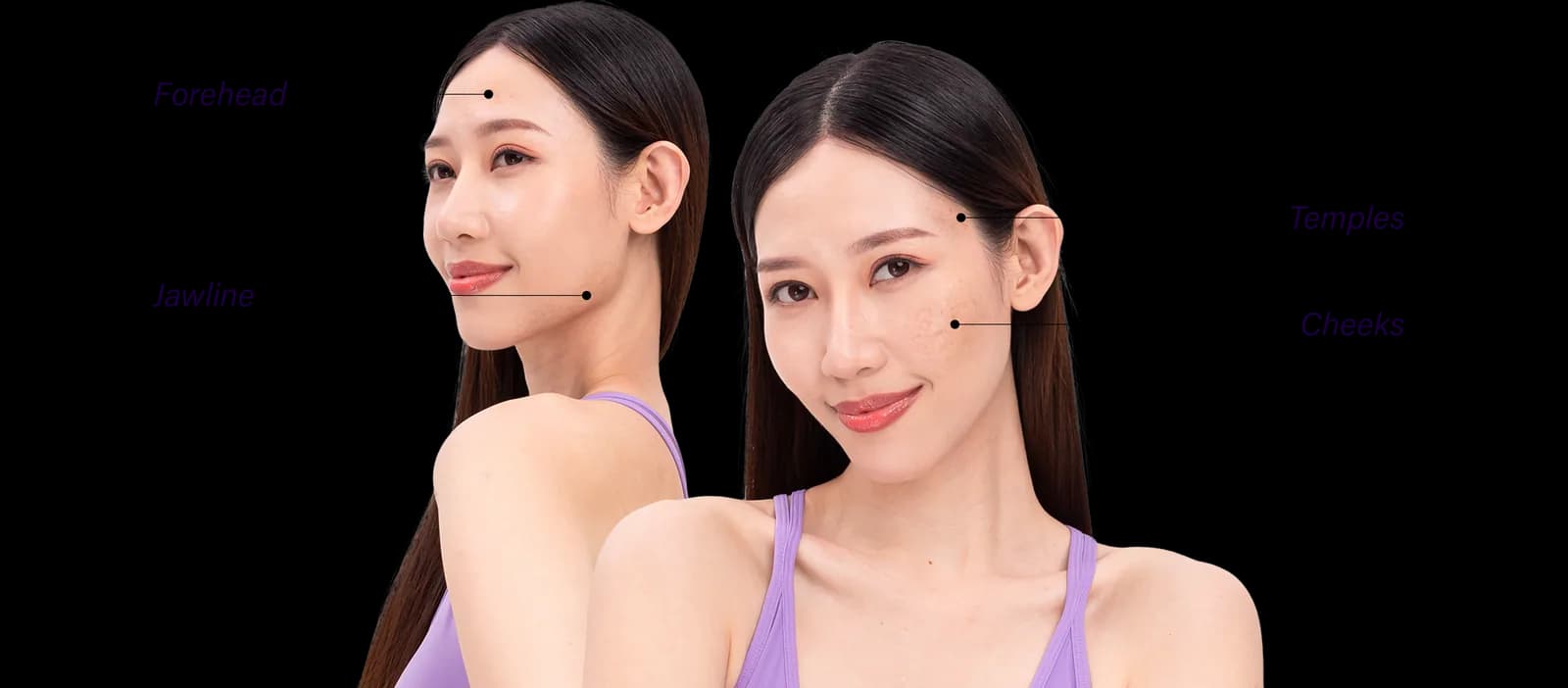 Areas of the face affected by acne scars