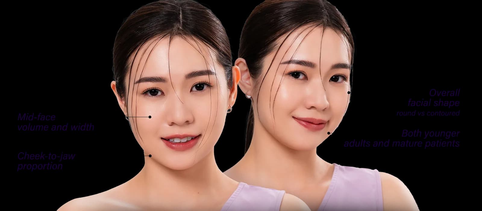 Areas of the face affected by chubby cheeks