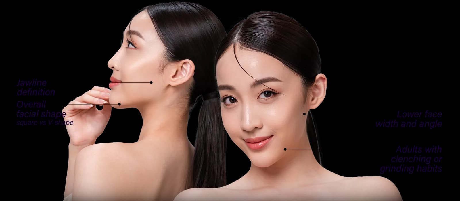 Areas of the face affected by square jaw