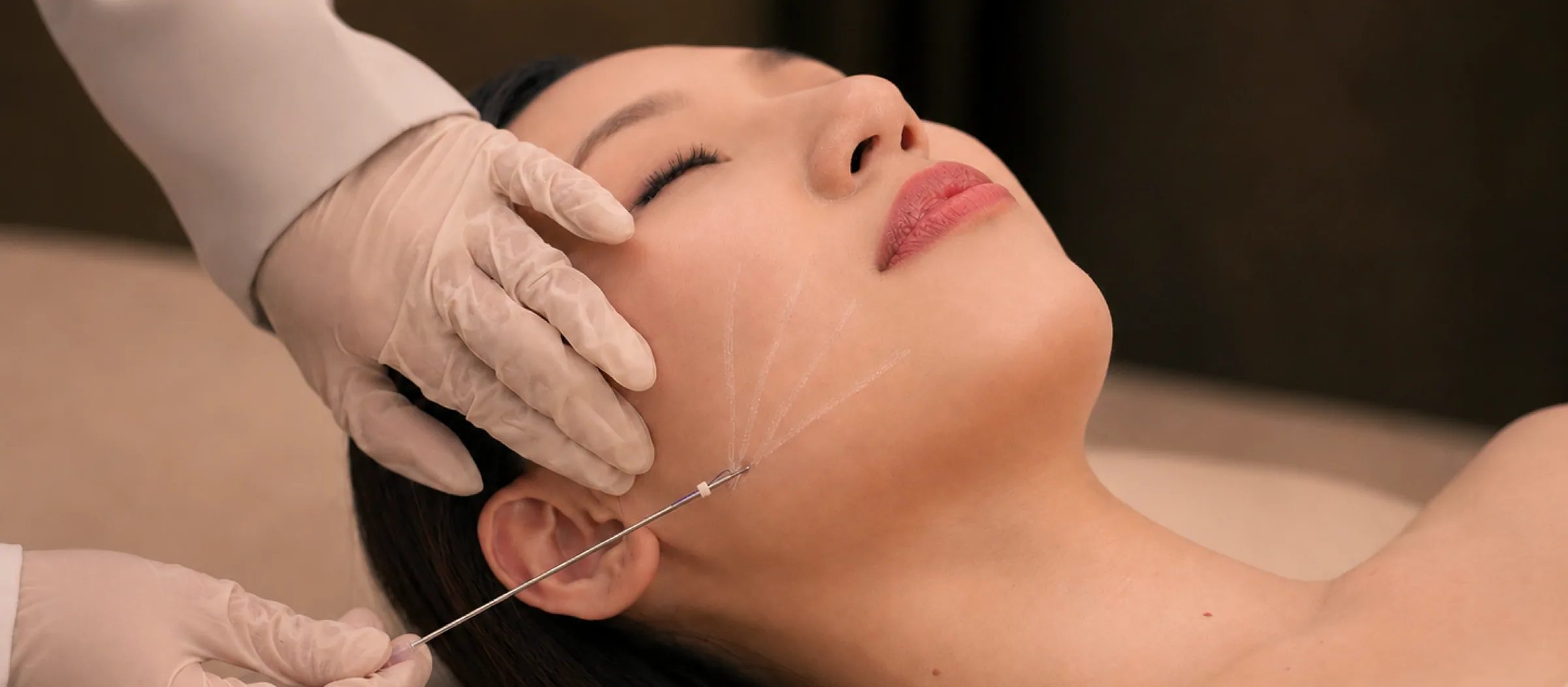 Face Thread Lift treatment in progress