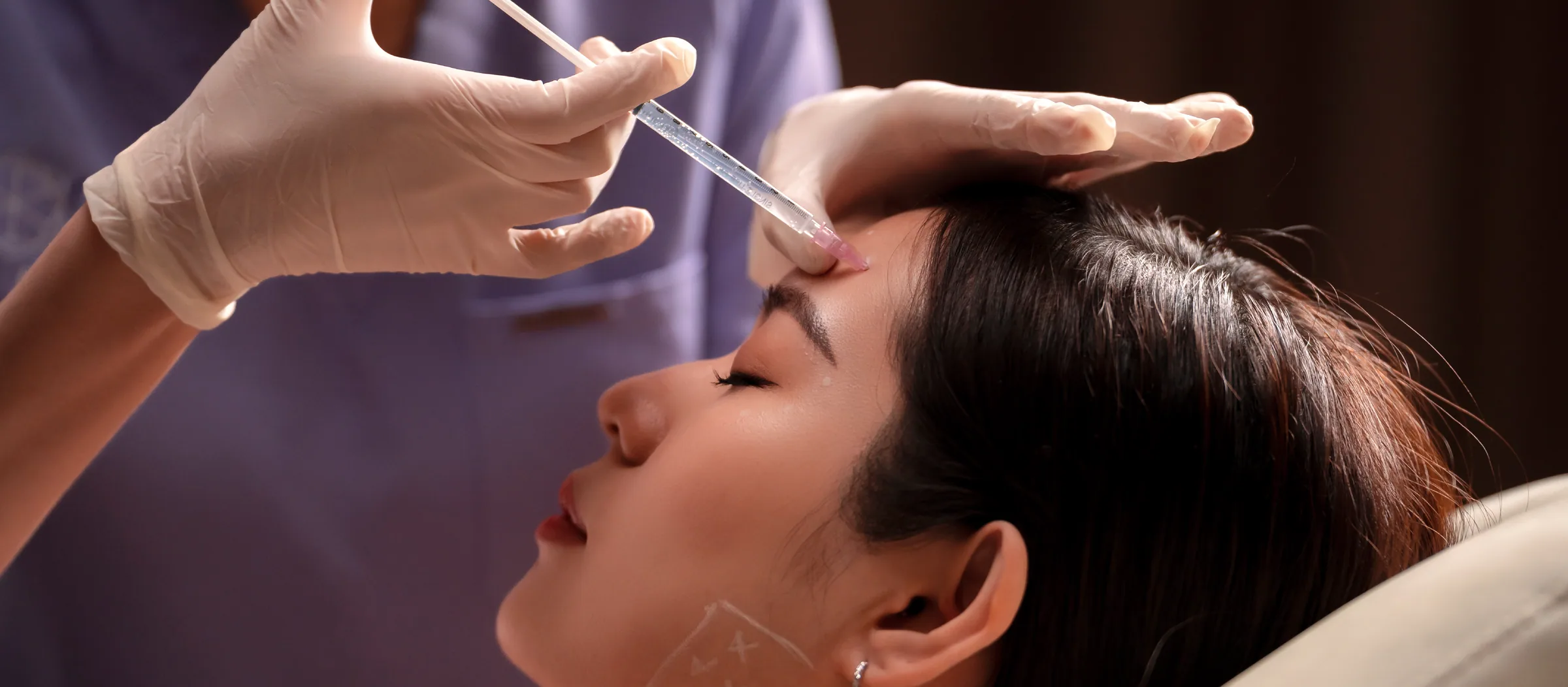 Radiesse treatment in progress