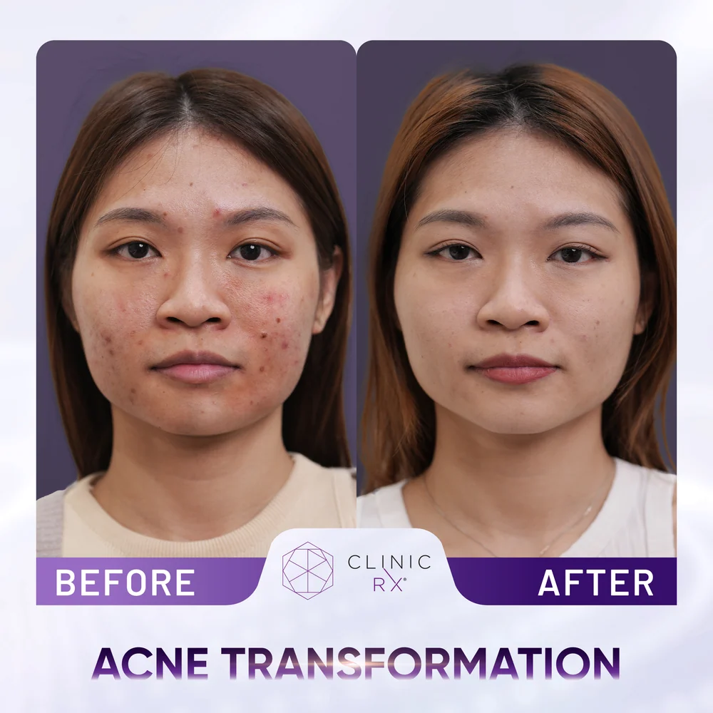 Acne result 3