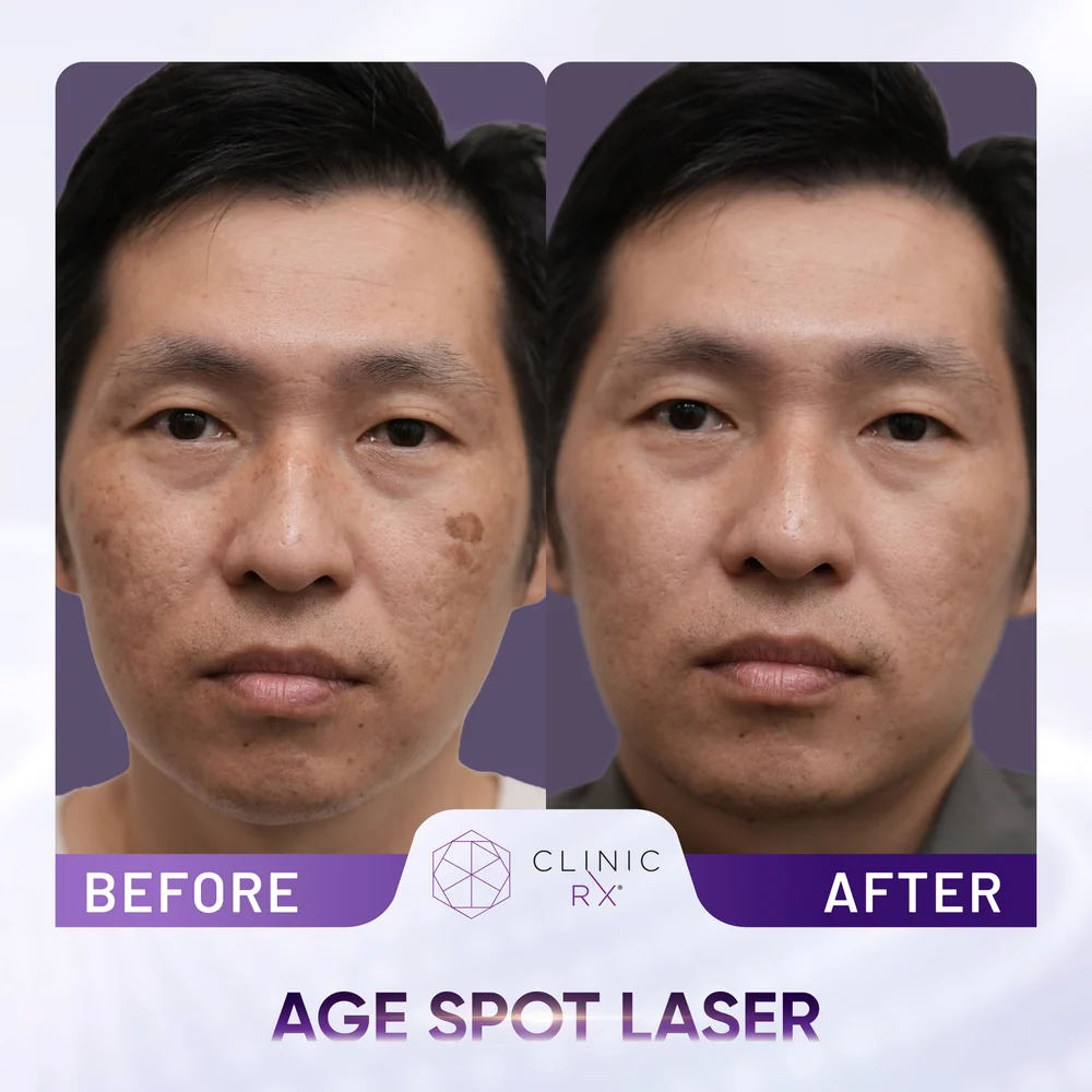 Uneven Skin Texture result 2