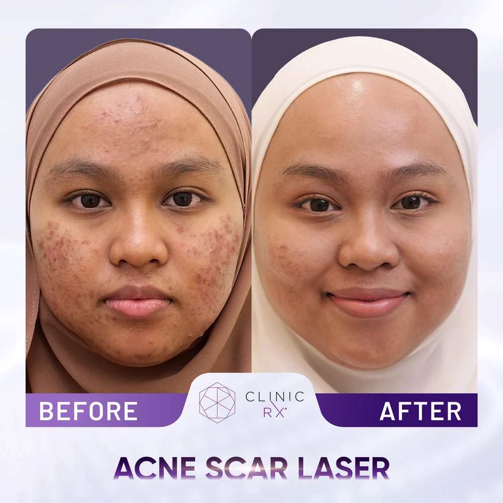 Uneven Skin Texture result 3