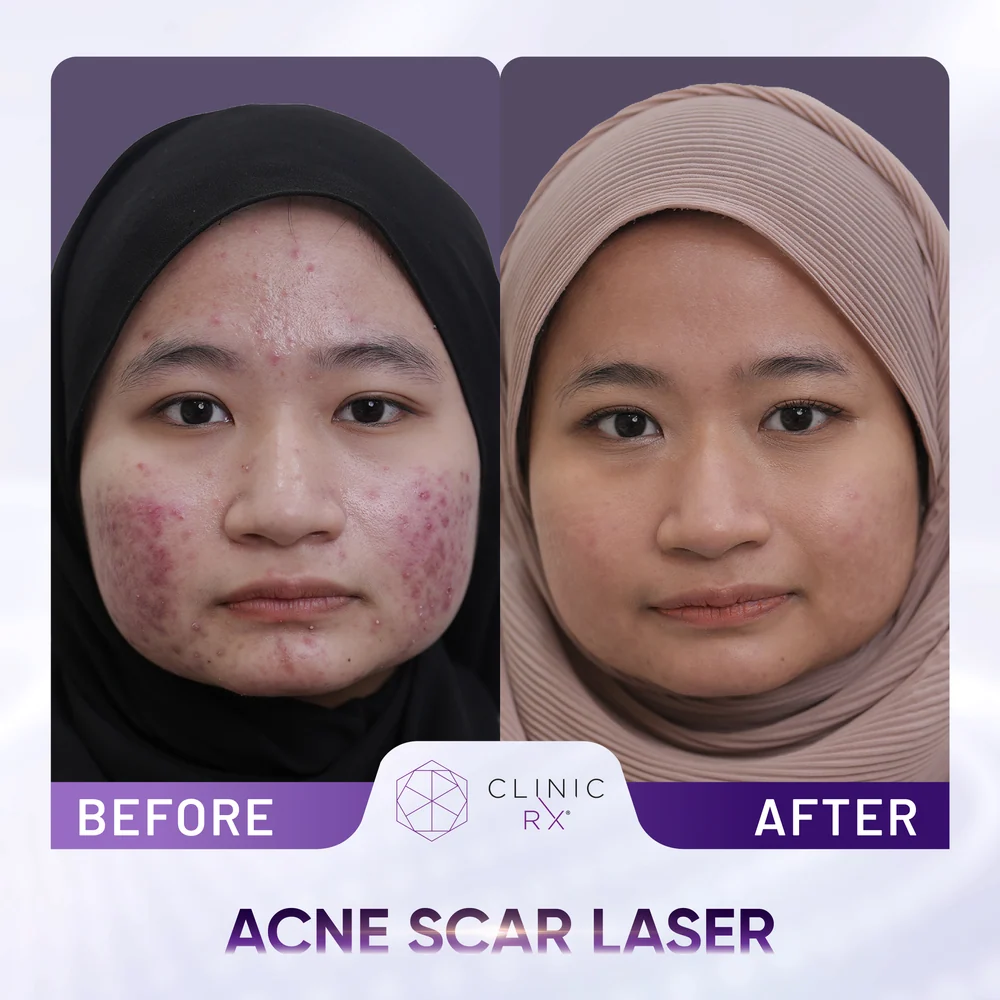 Uneven Skin Texture result 4