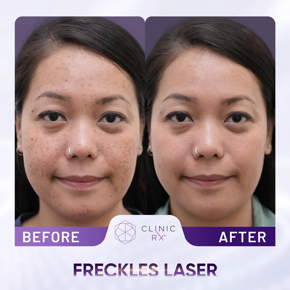 Uneven Skin Texture result 5