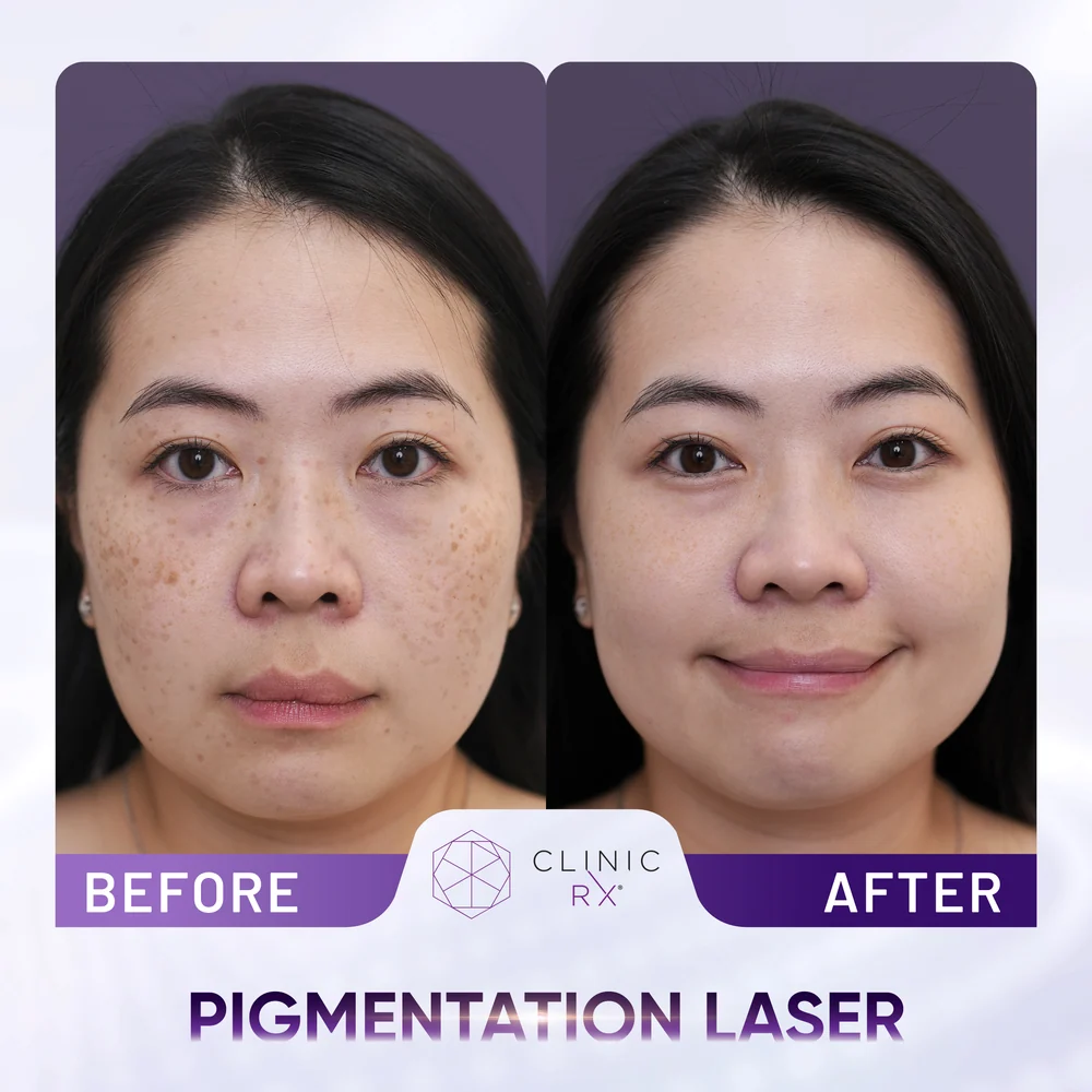 Uneven Skin Texture result 6