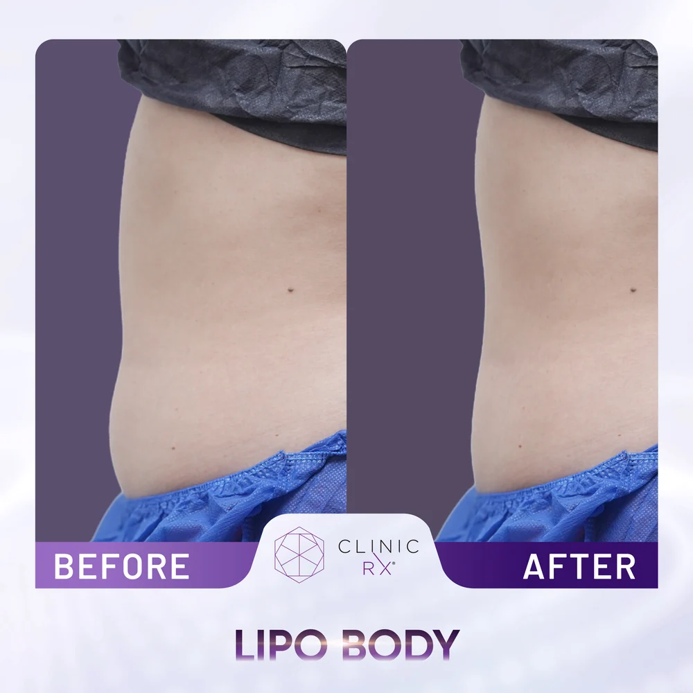 Unwanted Fat result 2