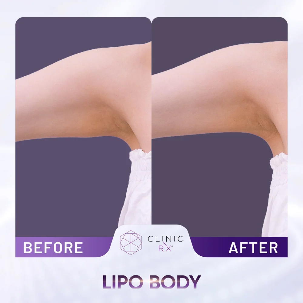 Unwanted Fat result 7