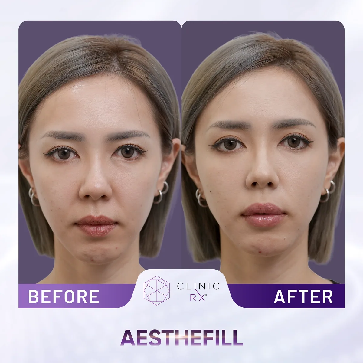 AestheFill actual result 1