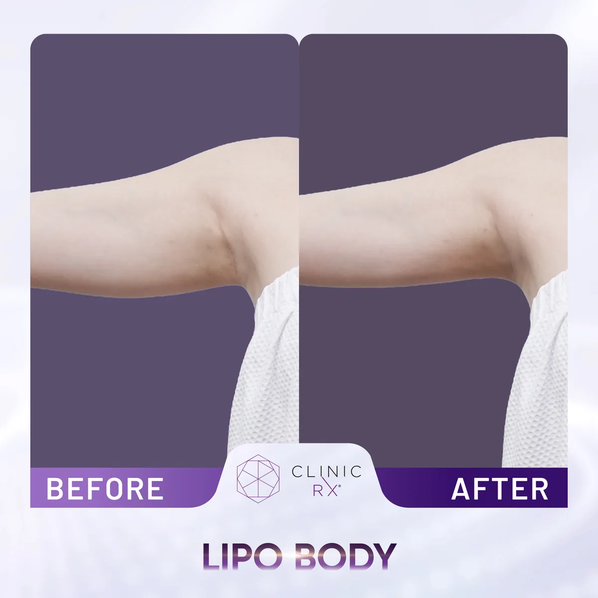 Lipo Body actual result 1