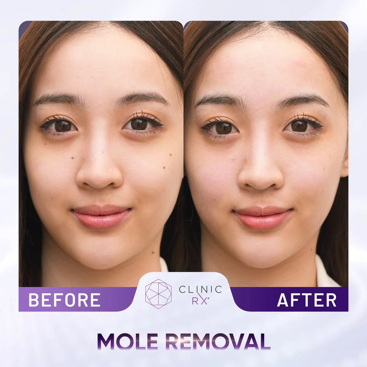 Milia & Mole Removal actual result 1