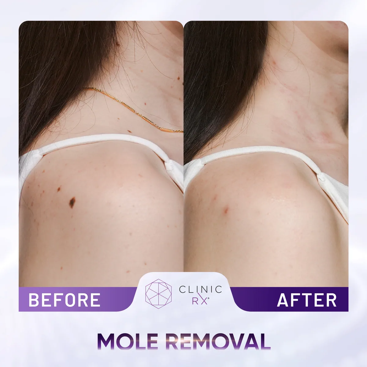Milia & Mole Removal actual result 2