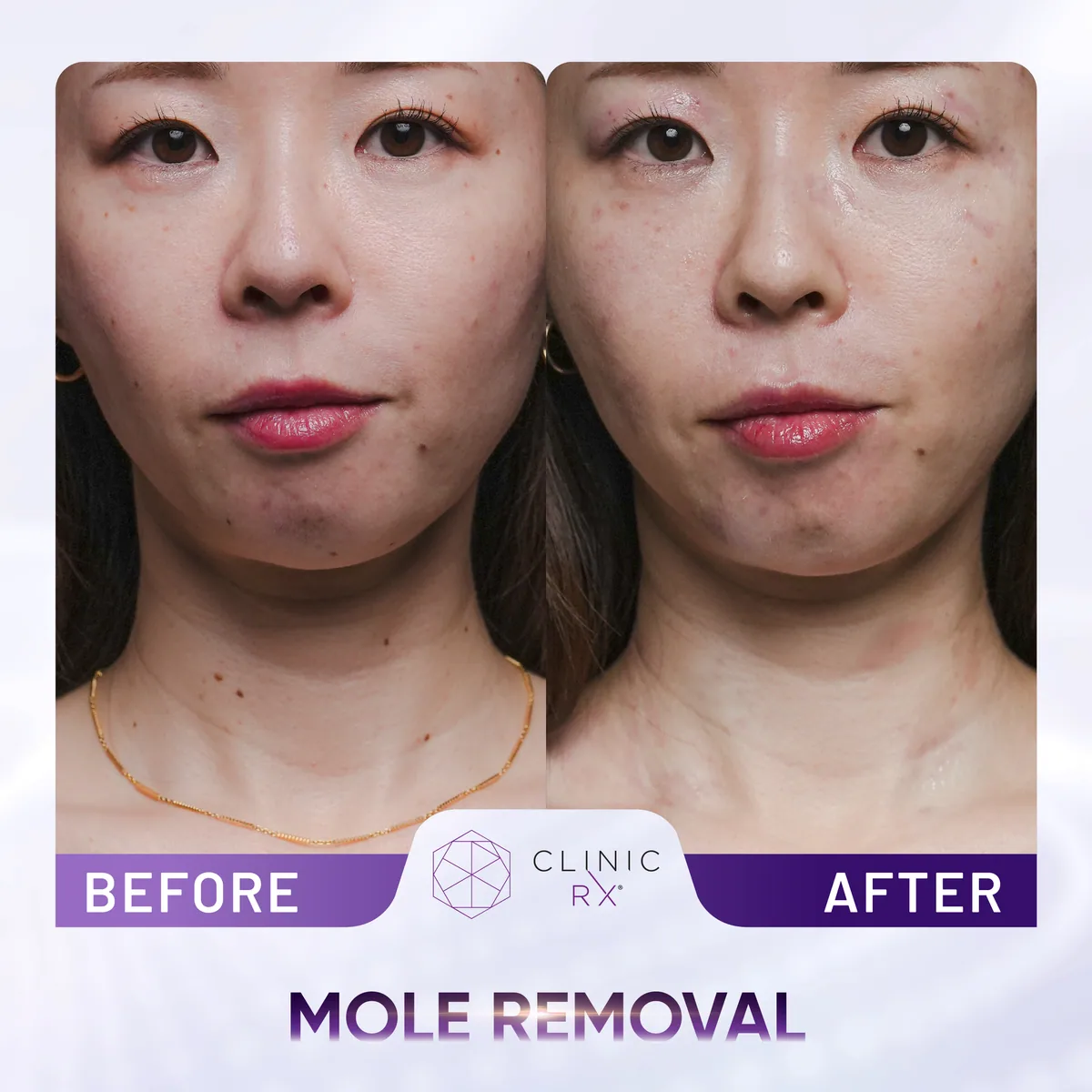 Milia & Mole Removal actual result 3