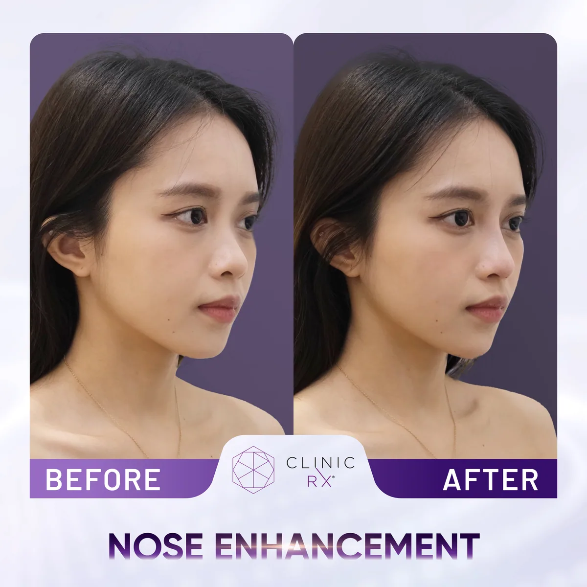 Nose Thread Lift actual result 1