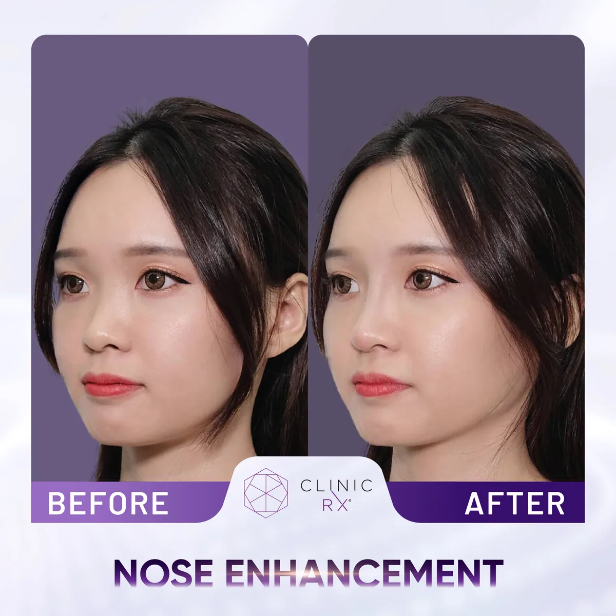 Nose Thread Lift actual result 2